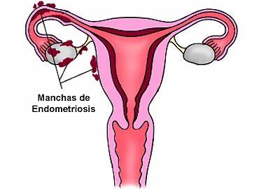 ENDOMETRIOSIS ¿EN QUÉ CONSISTE?