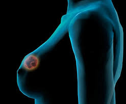Fibroadenoma: el tumor benigno de las mamas