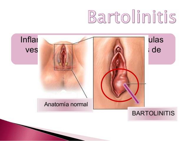Bartolinitis