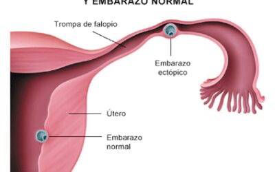 Embarazo Ectópico y Aborto