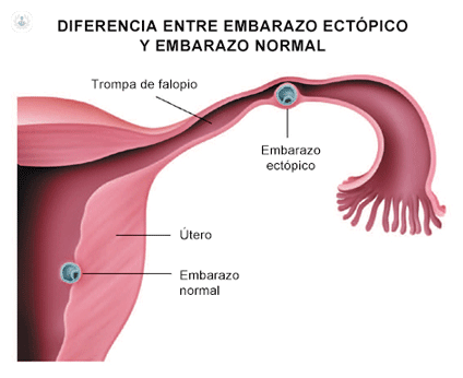 Embarazo Ectópico y Aborto