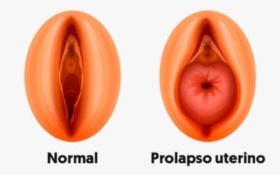 Prolapso genital