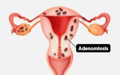 Adenomiosis Uterina