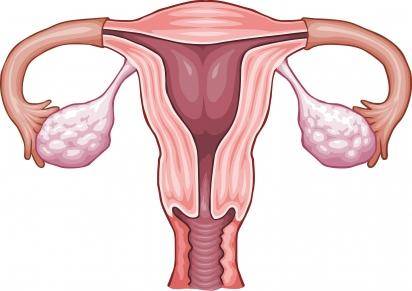 Sangrado uterino disfuncional o Hemorragia disfuncional