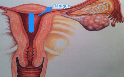 Malformación uterina: útero con tabique