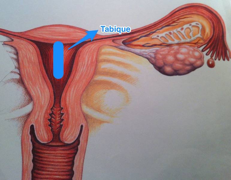 Malformación uterina: útero con tabique