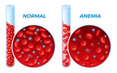 Anemia Ferropénica