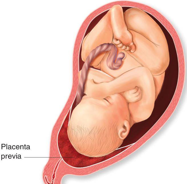 Placenta Previa y visita al ginecologo