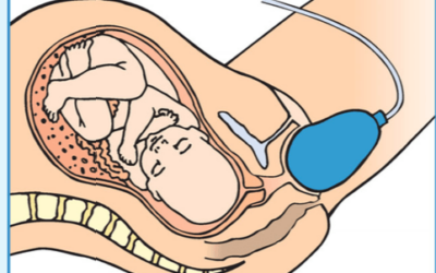 Ejercitadores de suelo pélvico para parto, postparto e incontinencia urinaria