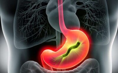 Qué es el Helicobacter Pylori