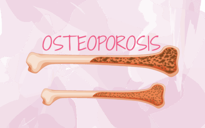 Osteoporosis y Menopausia