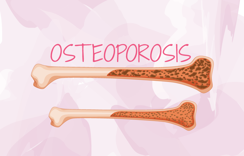 Osteoporosis y Menopausia