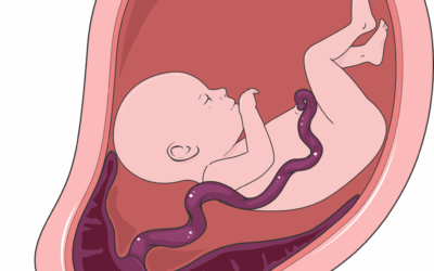 Placenta previa en el embarazo